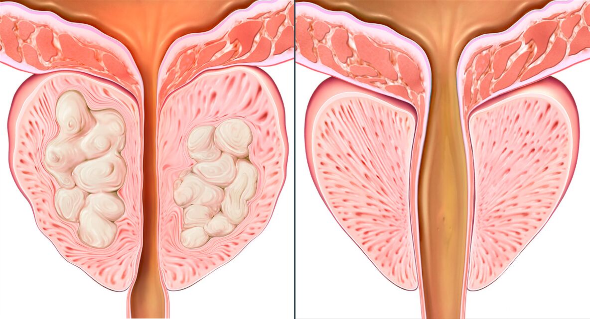 Fasi del trattamento della prostatite con Prostalix